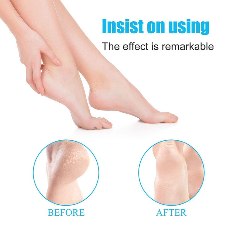 Foot Scrubber Callus Remover,Professional Pedicure Kit Heel Scraper for Feet Dead Skin Removal, Cracking, Hard Cracked Dry Skin Removal, Wet and Dry Feet.