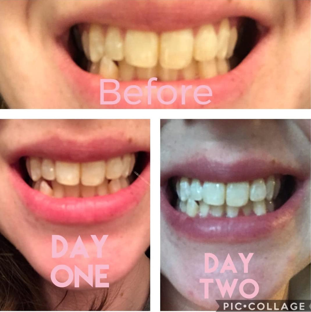 Dr Song Teeth Whitening Kit 3X Syringes 35% Carbamide P