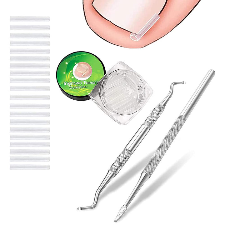 (50 +2) Pack Professional Ingrown Toenail Correction Treatment Kit, 50 Pcs Ingrown Toenail Corrector Straightener Strips Recover Clips with 2 Pcs Ingrown Toenail File And Lifter