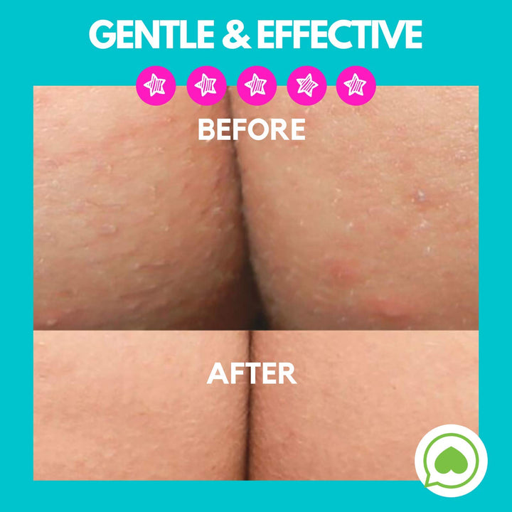 Butt Acne Clearing Lotion for back, buttocks, thighs - Clears away acne breakouts and reveals new brighter skin
