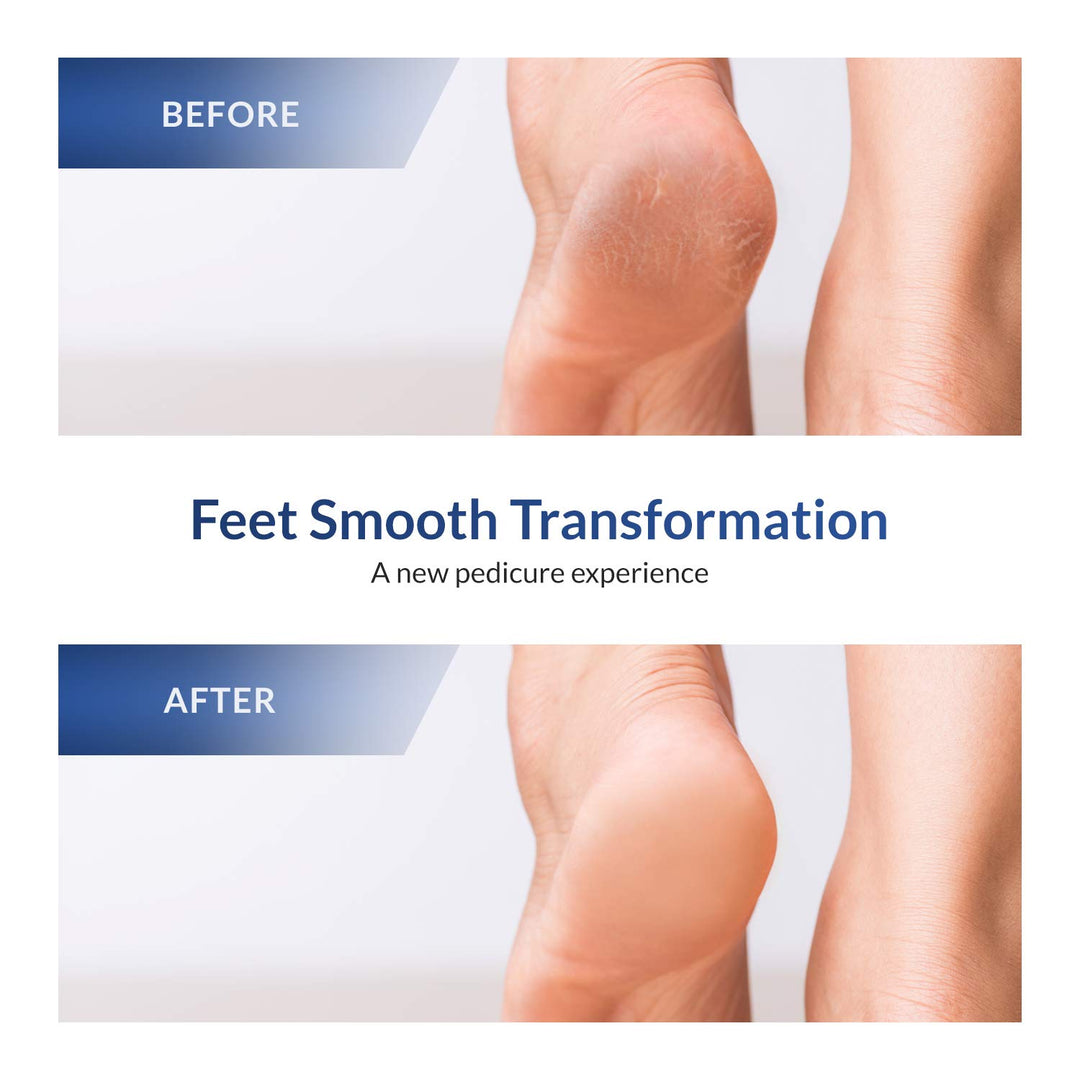 Professional Pedicure Stainless Steel Foot Scrubber Callus Remover Double-Side Foot Scraper for Coarse Cracked Heel Foot File for Hard Dead Feet Skin Ped Egg for Both Men and Women