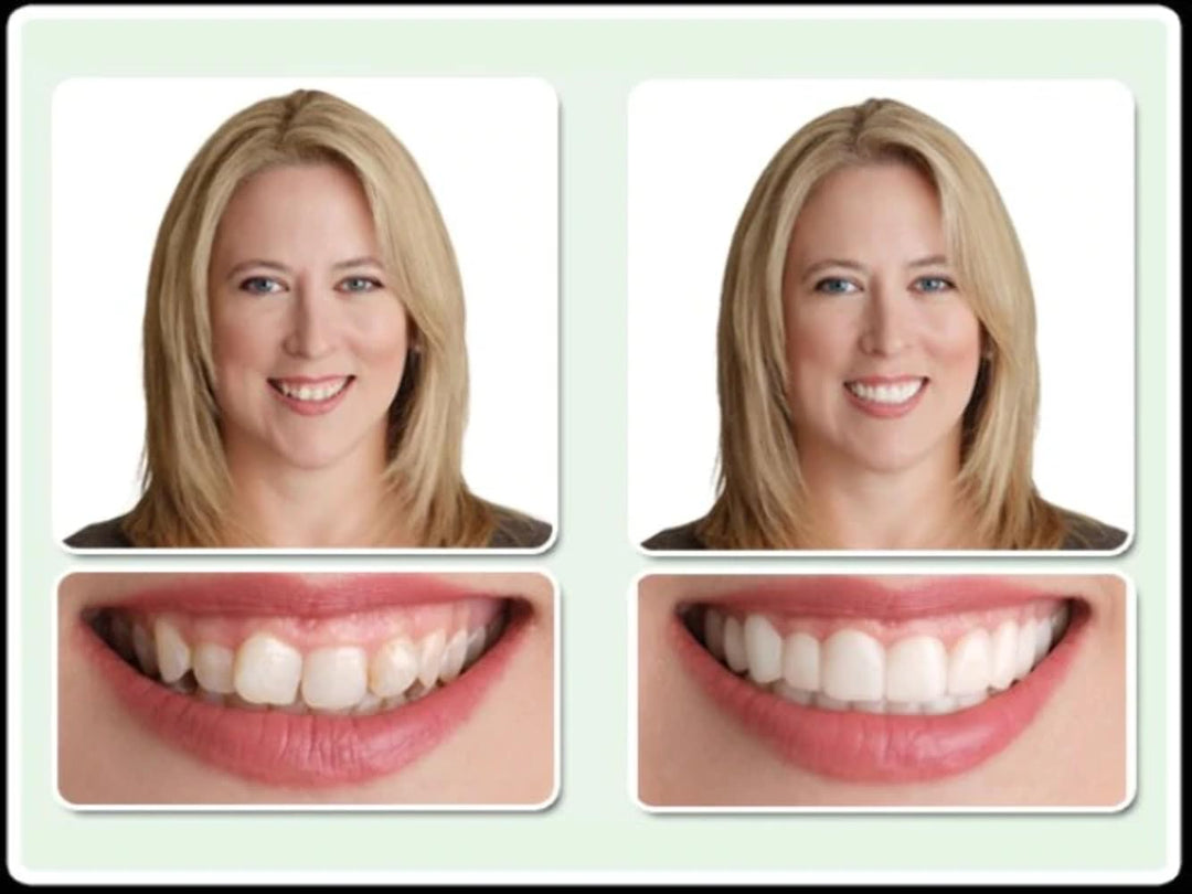 Dr. Bailey&#39;s Secure Instant Smile Upper -One Si