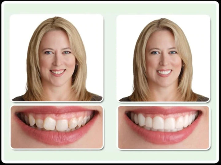 Dr. Bailey&#39;s Secure Instant Smile Upper -One Si
