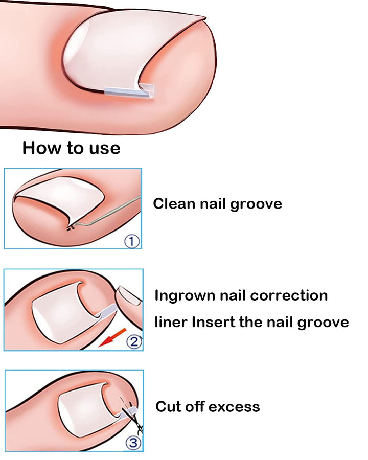 (50 +2) Pack Professional Ingrown Toenail Correction Treatment Kit, 50 Pcs Ingrown Toenail Corrector Straightener Strips Recover Clips with 2 Pcs Ingrown Toenail File And Lifter