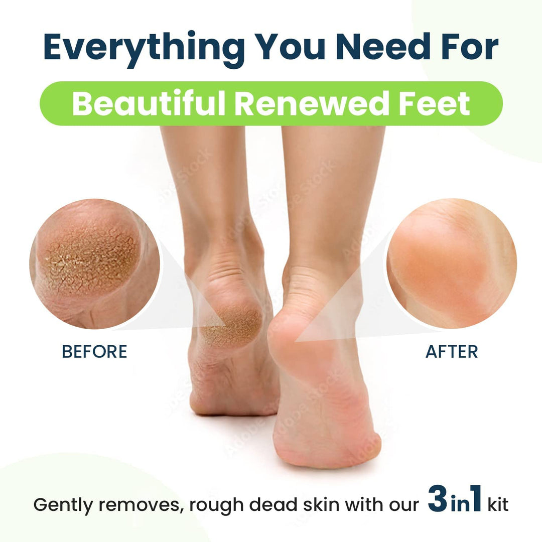 Callus Remover for Feet with Extra Strength Gel &amp; Foot Pumice Stone Set - Easy Way to Remove Hard Calluses &amp; Dead Skin Build-Up - Professional at-Home Foot Care for Men &amp; Women - Made in The USA