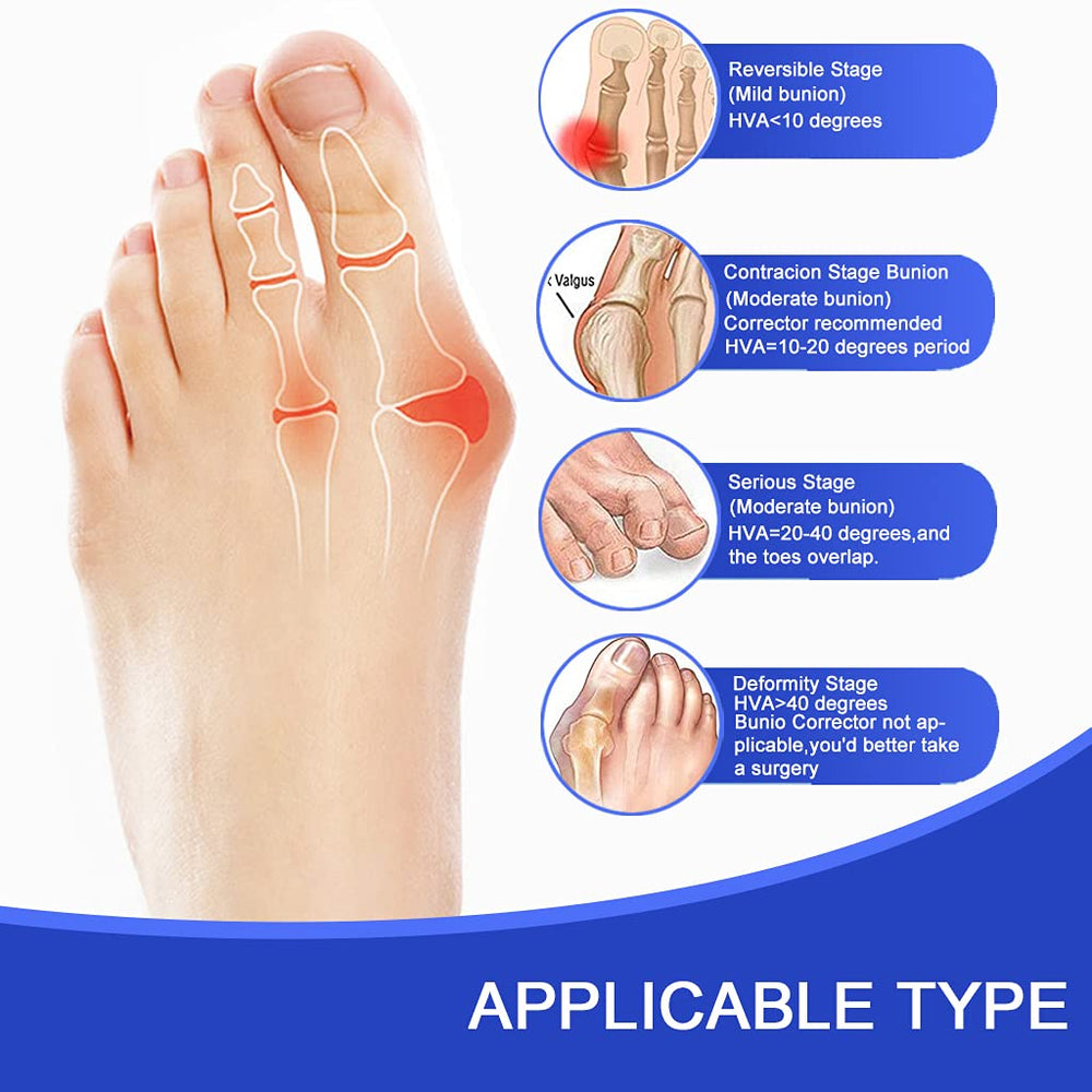 Toe Corrector Toe Separator Bunion Splint 2024 Updated 