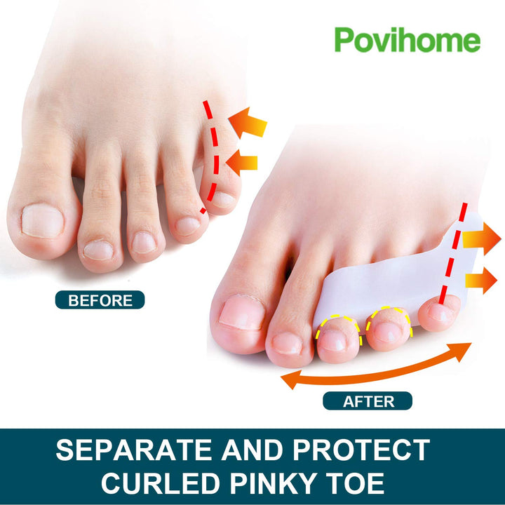 5 Pairs Updated Pinky Toe Straightener: Povihome Pinky 