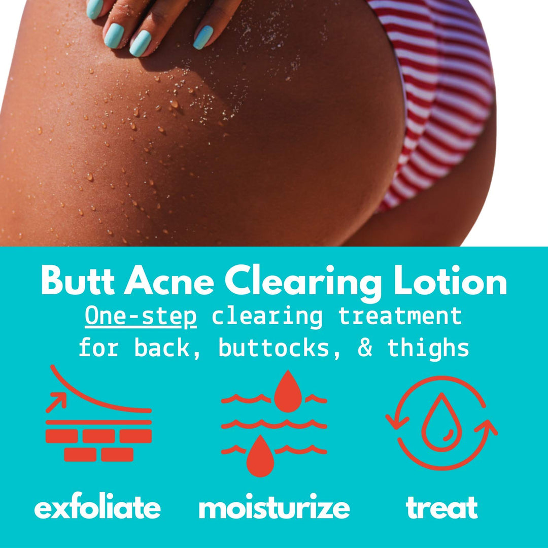 Butt Acne Clearing Lotion for back, buttocks, thighs - Clears away acne breakouts and reveals new brighter skin