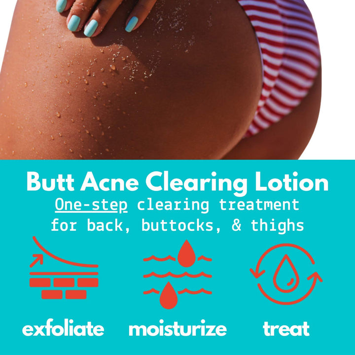 Butt Acne Clearing Lotion for back, buttocks, thighs - Clears away acne breakouts and reveals new brighter skin