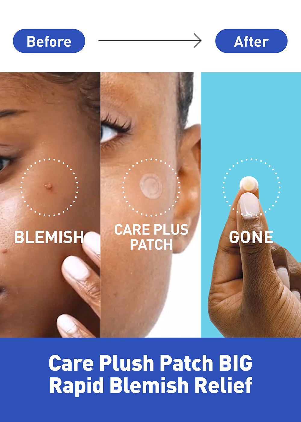 Care Plus Spot Patch Big (81 Count) | Hydrocolloid Patch, Spot Stickers for Acne Pimple Blemishes and Zits