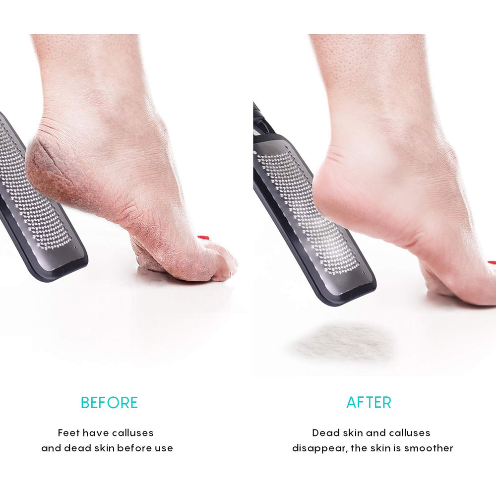 Foot Scrubber Pedicure Tools Rasp - 5 PCS Foot File Callus Remover For Feet To Remove Hard Skin - 2 X Stainless Steel Black, 3 X Plastic Blue