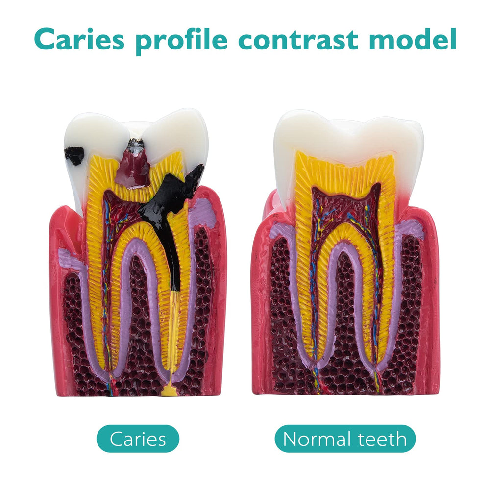 Dental Caries Teeth Model - Anatomy Education Model Caries Bilateral Comparison Study Model 6 Times Cross-Section Demonstration Model Tooth Decay Props for Science Teaching