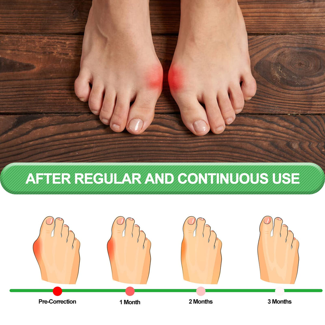 EDNYZAKRN Bunion Corrector, Orthopedic Bunion Splint, B
