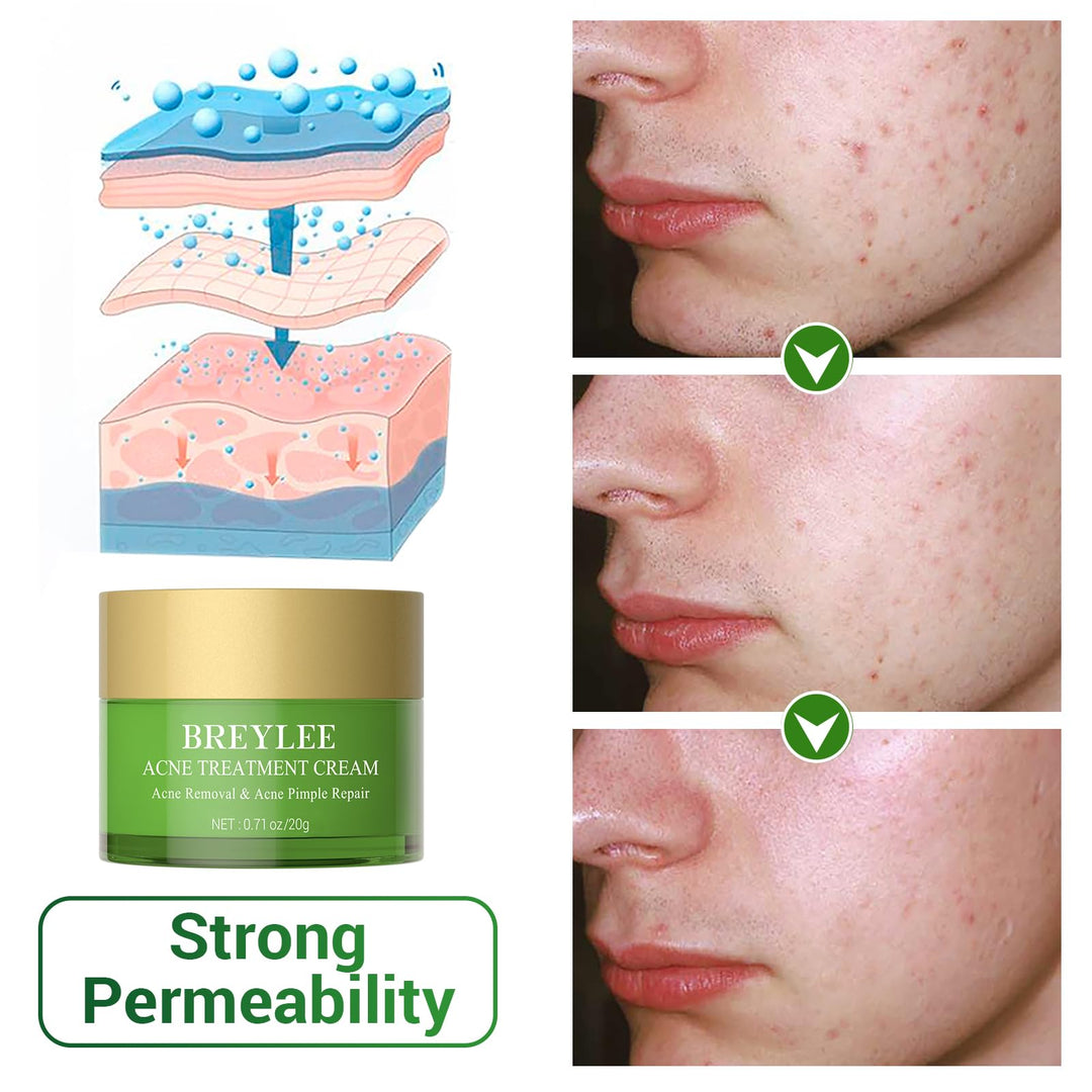 Acne Treatment Cream, Tea Tree Oil Acne Cream for Clearing Severe Acne, Breakout, Remove Pimple and Repair Skin (20ml,0.7oz)