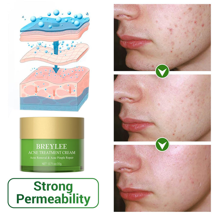 Acne Treatment Cream, Tea Tree Oil Acne Cream for Clearing Severe Acne, Breakout, Remove Pimple and Repair Skin (20ml,0.7oz)