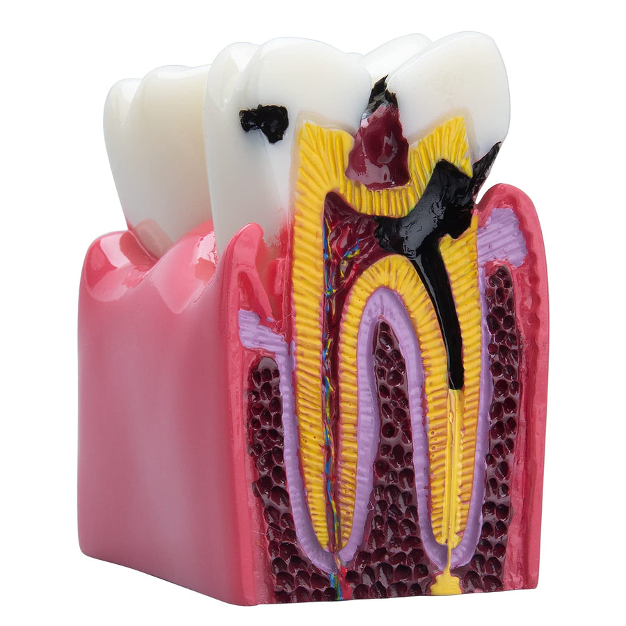 Dental Caries Teeth Model - Anatomy Education Model Caries Bilateral Comparison Study Model 6 Times Cross-Section Demonstration Model Tooth Decay Props for Science Teaching
