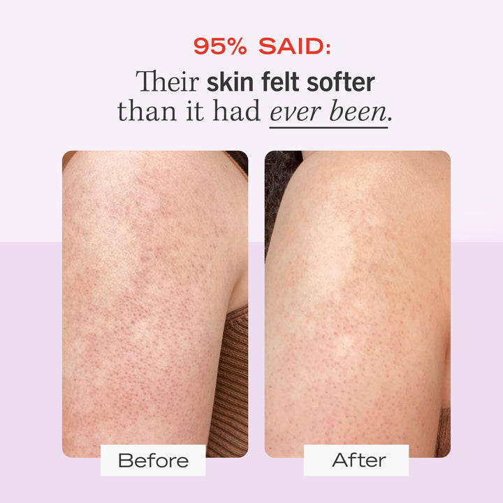 First Aid Beauty KP Bump Eraser Body Scrub Exfoliant fo