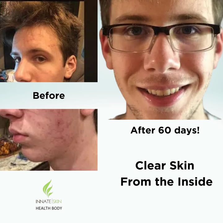 Clear Skin Acne Vitamin System | 20 Antioxidants, Botanicals &amp; Minerals | 60 Count Pack of 2