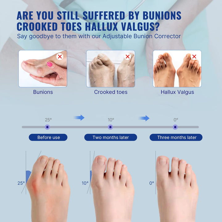 Fitgeno Bunion Corrector Women & Men Big Toe: Foot Straightener Splint Brace - Adjustable Bunyan Correction Orthopedic for Hallux Valgus Pain Relief 2 Pcs