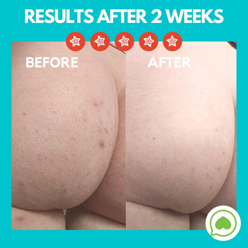 Butt Acne Clearing Lotion for back, buttocks, thighs - Clears away acne breakouts and reveals new brighter skin