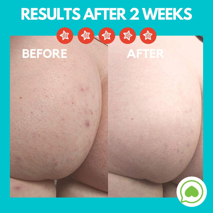 Butt Acne Clearing Lotion for back, buttocks, thighs - Clears away acne breakouts and reveals new brighter skin