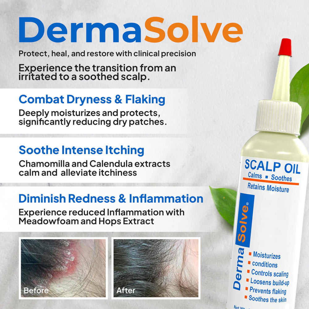 Psoriasis & Dandruff Scalp Oil, Dermatologist Approved for Flaky Scalp Relief