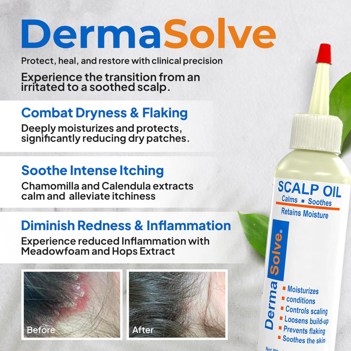 Psoriasis &amp; Dandruff Scalp Oil, Dermatologist Approved for Flaky Scalp Relief