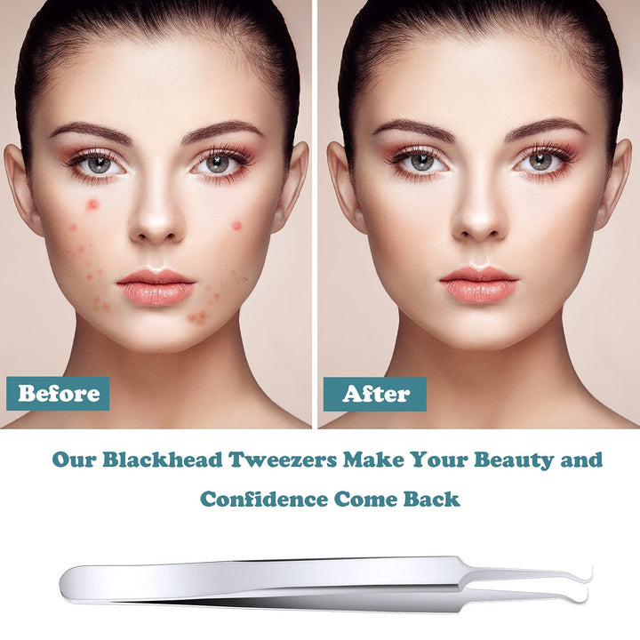 ANCIRS 6 Pack Acne Pimple Blackhead Remover Tweezers, S