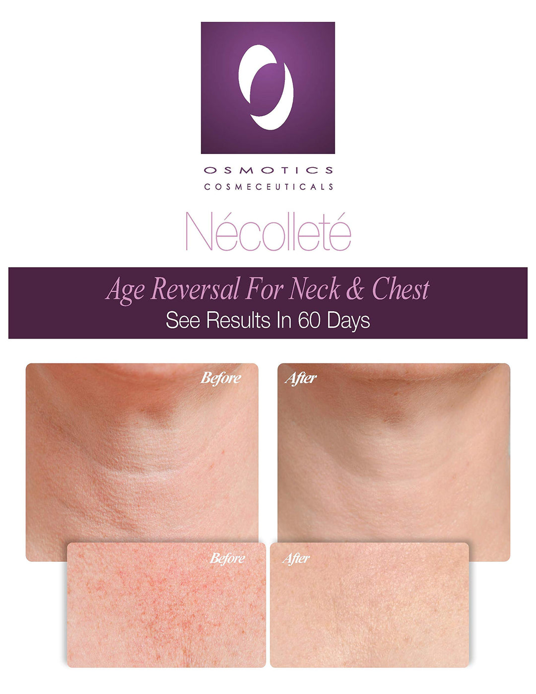 Necollete Age Reversal For Neck and Chest, 1.7 Oz