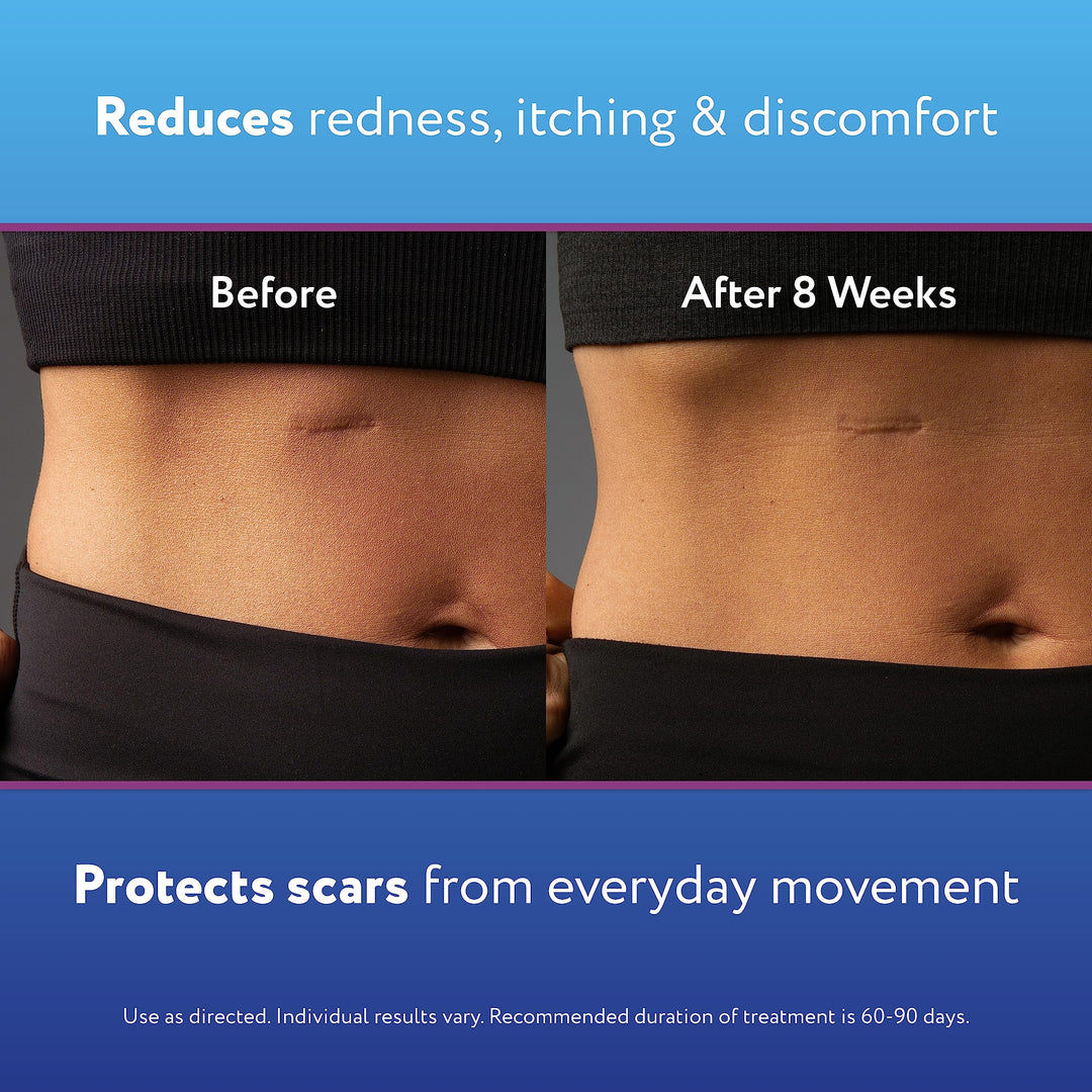 ScarAway 100% Medical-Grade Silicone Scar Gel for Face,